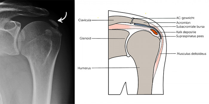 De Behandeling Van Calcificerende Tendinopathie Van De Schouder Huisarts And Wetenschap